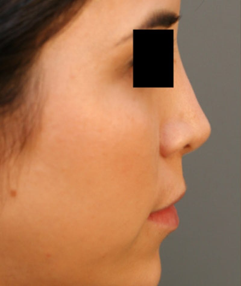 Ethnic Rhinoplasty Before & After Gallery - Patient 108189860 - Image 1