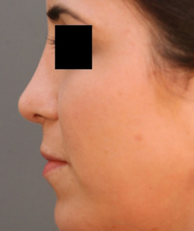 Ethnic Rhinoplasty Before & After Gallery - Patient 108189860 - Image 2