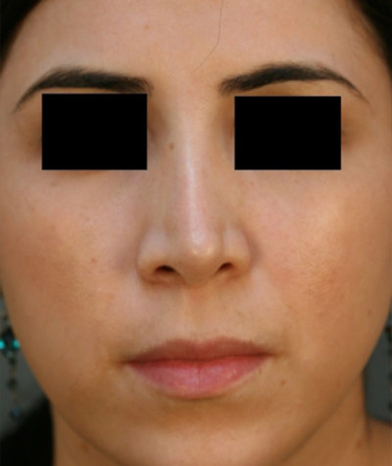 Ethnic Rhinoplasty Before & After Gallery - Patient 108189860 - Image 3