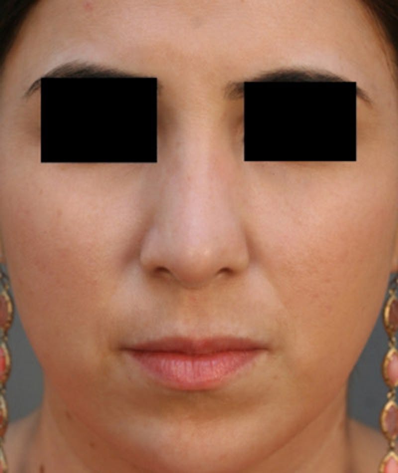 Ethnic Rhinoplasty Before & After Gallery - Patient 108189860 - Image 4