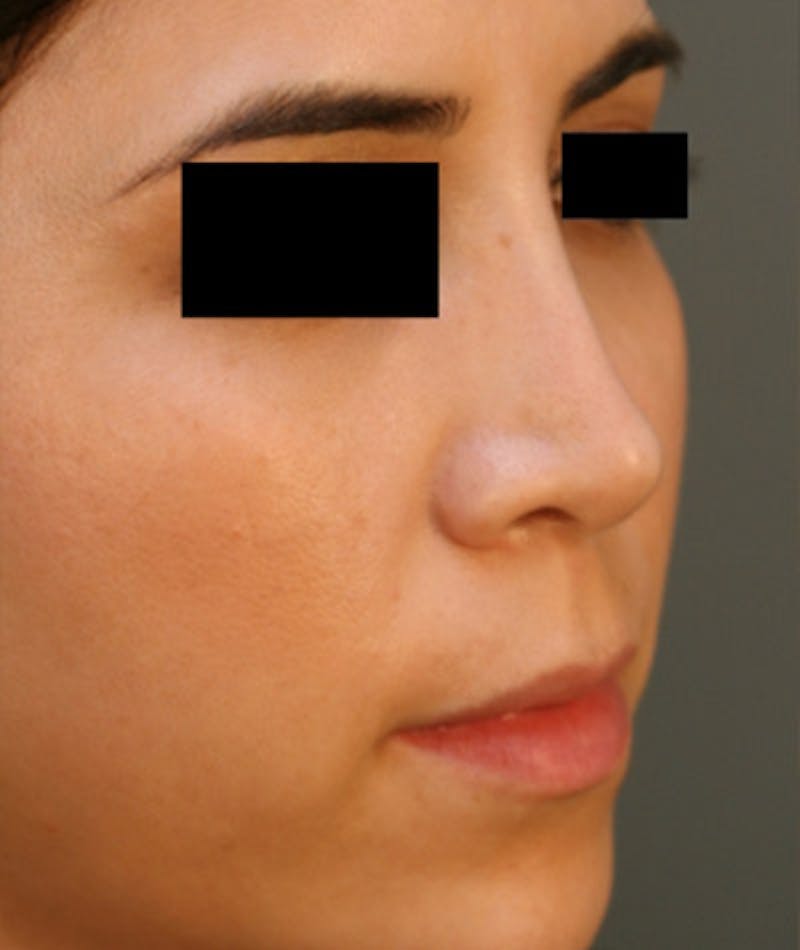Ethnic Rhinoplasty Before & After Gallery - Patient 108189860 - Image 5