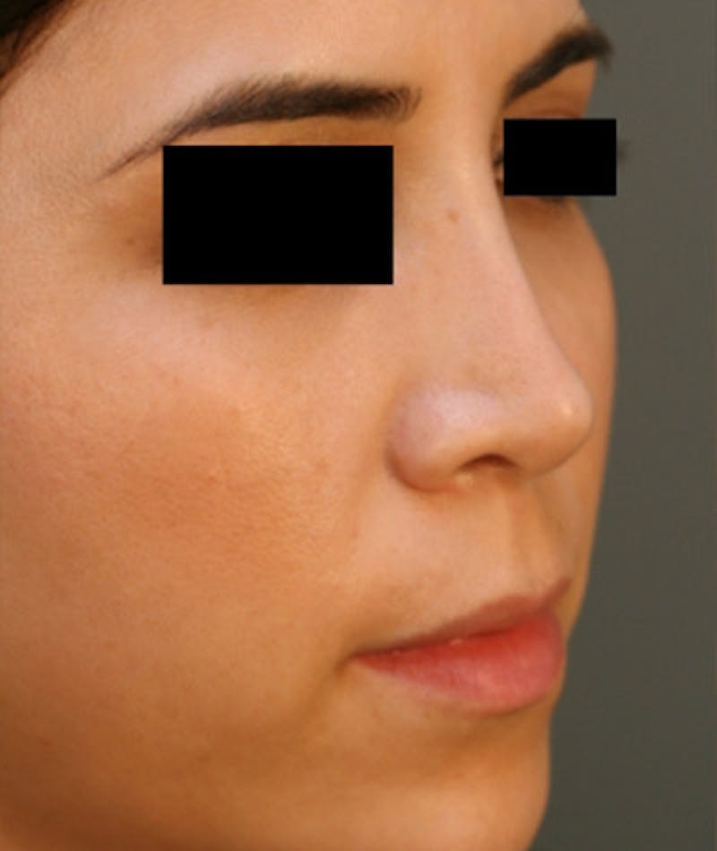 Ethnic Rhinoplasty Before & After Gallery - Patient 108189860 - Image 5
