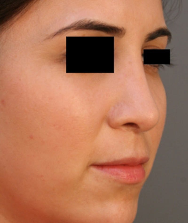 Ethnic Rhinoplasty Before & After Gallery - Patient 108189860 - Image 6