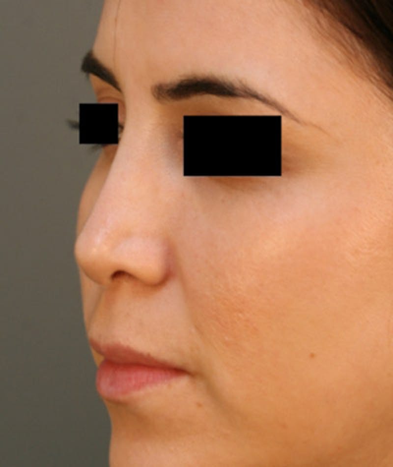 Ethnic Rhinoplasty Before & After Gallery - Patient 108189860 - Image 7