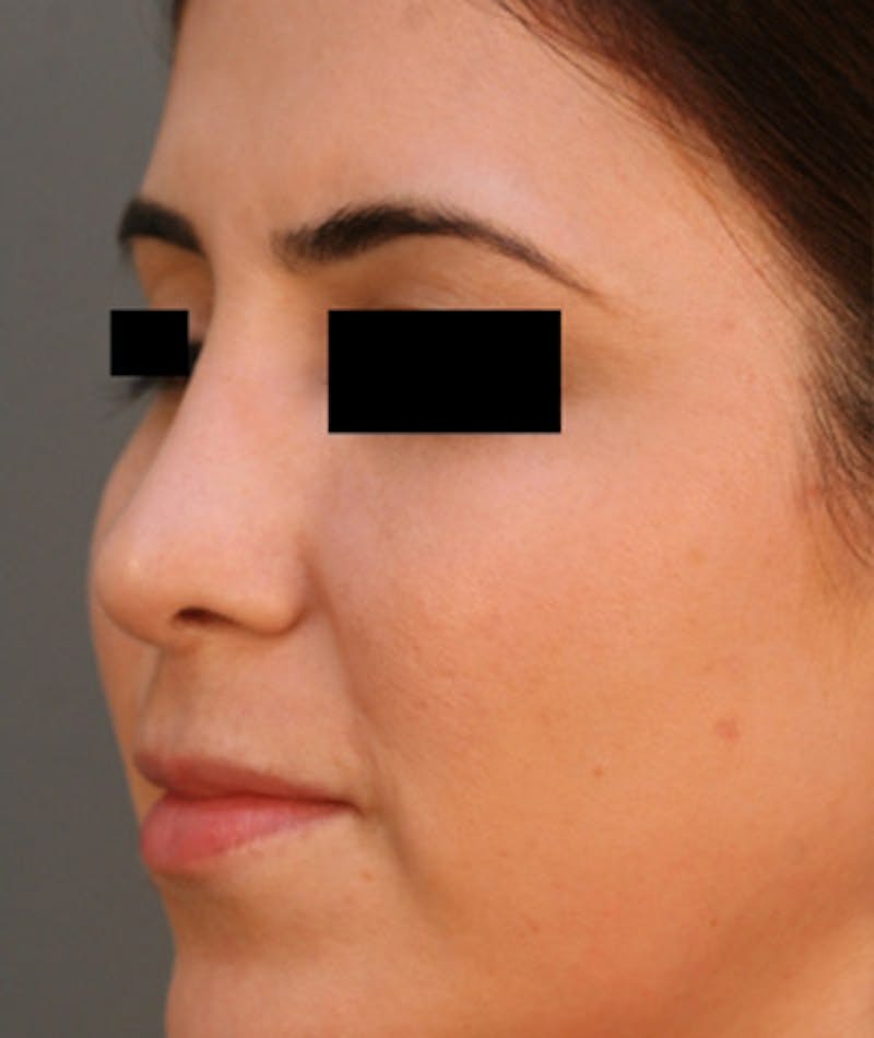 Ethnic Rhinoplasty Before & After Gallery - Patient 108189860 - Image 8