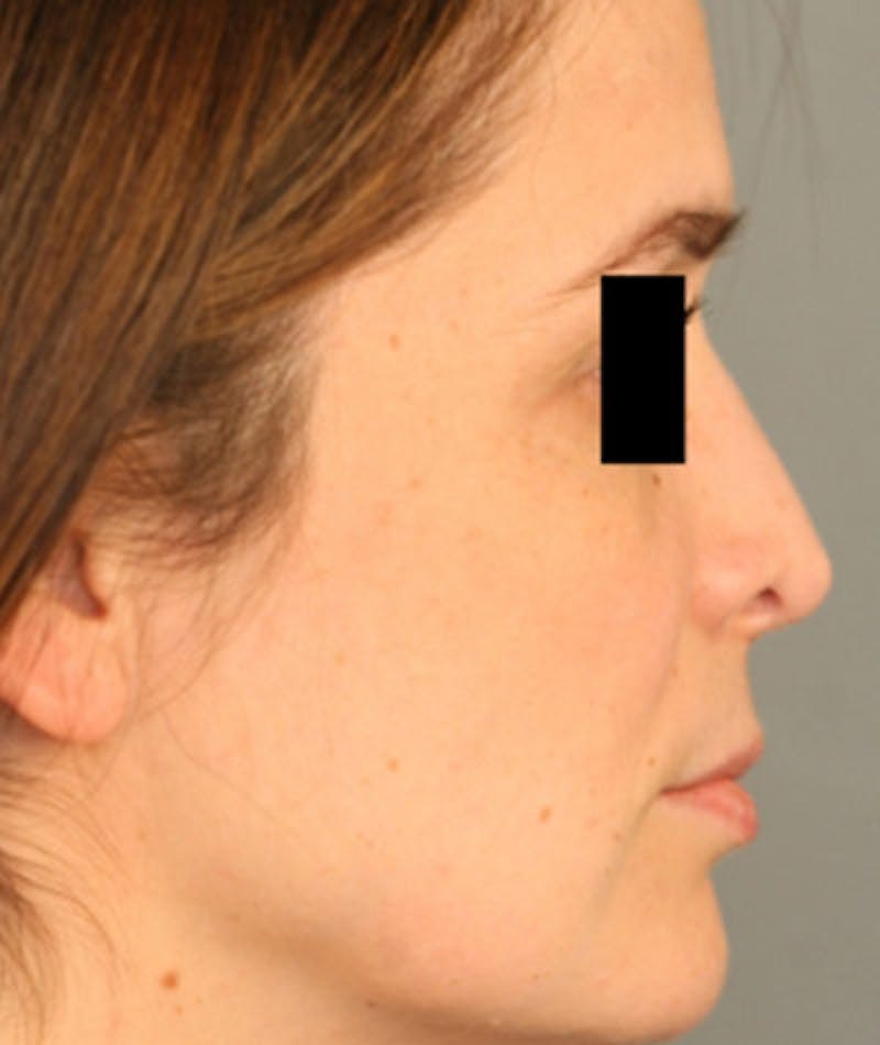 Ethnic Rhinoplasty Before & After Gallery - Patient 108189861 - Image 1
