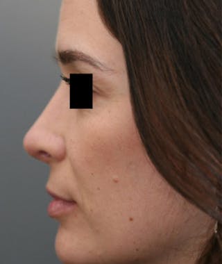 Ethnic Rhinoplasty Before & After Gallery - Patient 108189861 - Image 2