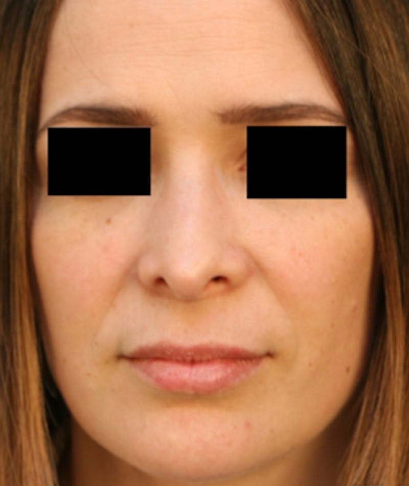 Ethnic Rhinoplasty Before & After Gallery - Patient 108189861 - Image 3
