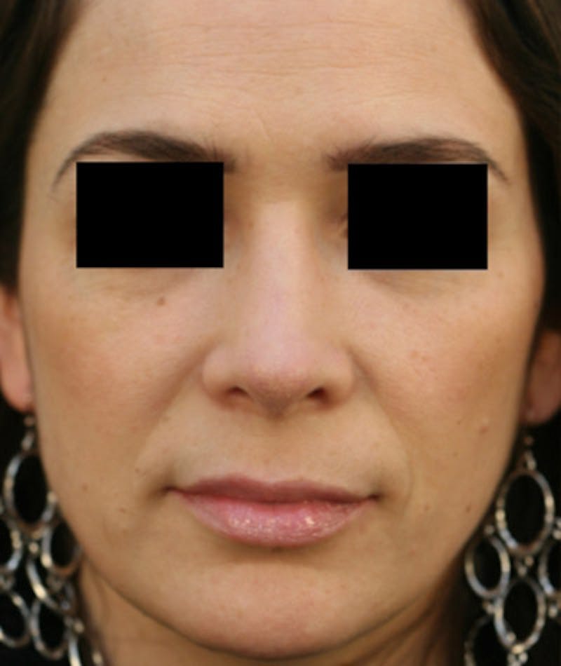 Ethnic Rhinoplasty Before & After Gallery - Patient 108189861 - Image 4