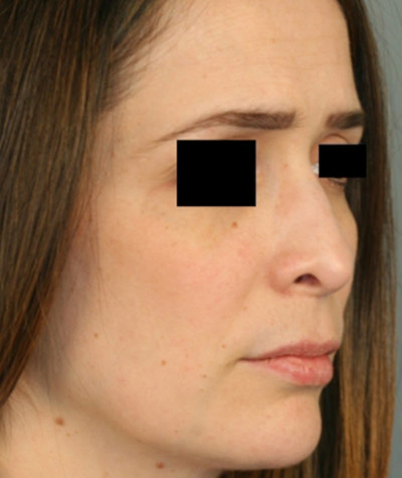Ethnic Rhinoplasty Before & After Gallery - Patient 108189861 - Image 5
