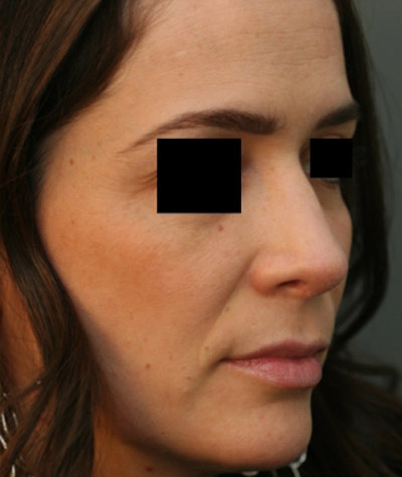 Ethnic Rhinoplasty Before & After Gallery - Patient 108189861 - Image 6