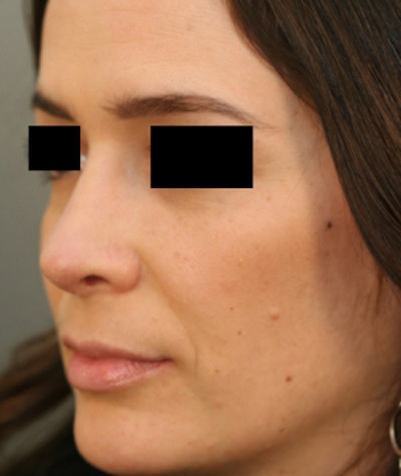 Ethnic Rhinoplasty Before & After Gallery - Patient 108189861 - Image 8