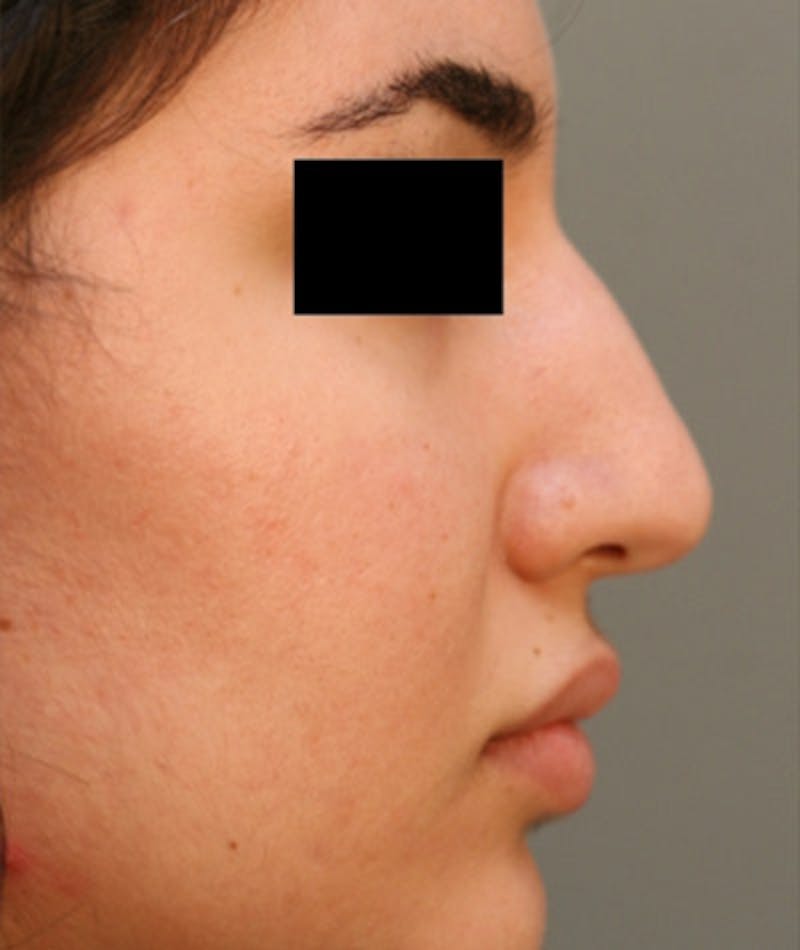 Ethnic Rhinoplasty Before & After Gallery - Patient 108189863 - Image 1