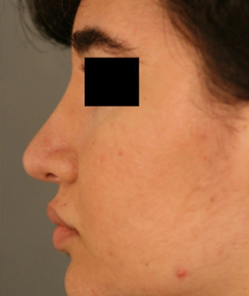 Ethnic Rhinoplasty Before & After Gallery - Patient 108189863 - Image 2