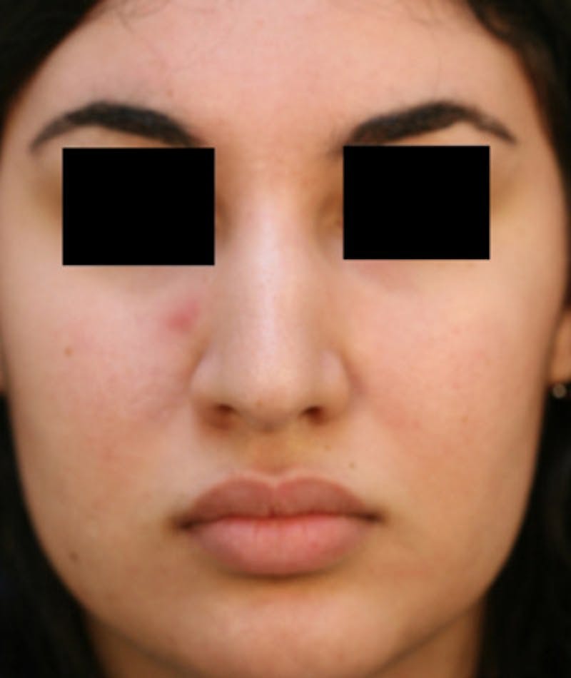 Ethnic Rhinoplasty Before & After Gallery - Patient 108189863 - Image 3