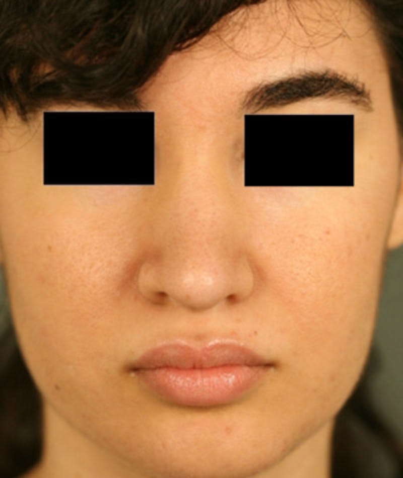 Ethnic Rhinoplasty Before & After Gallery - Patient 108189863 - Image 4