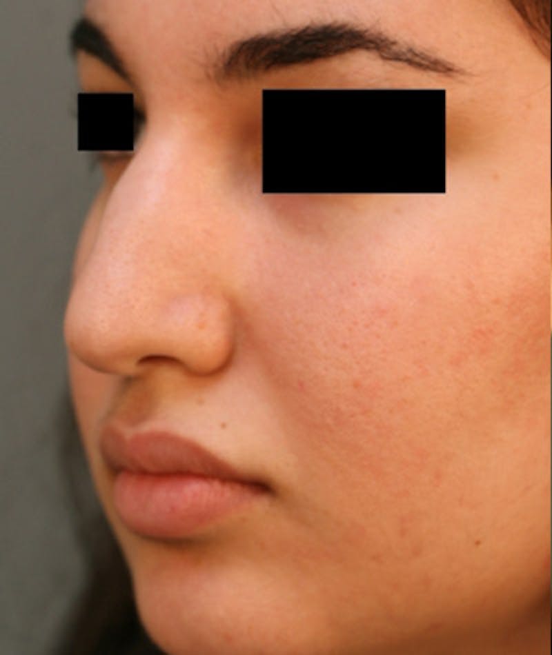 Ethnic Rhinoplasty Before & After Gallery - Patient 108189863 - Image 5