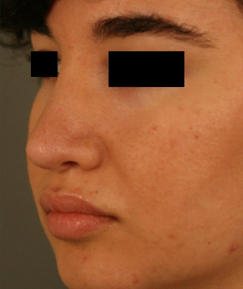 Ethnic Rhinoplasty Before & After Gallery - Patient 108189863 - Image 6