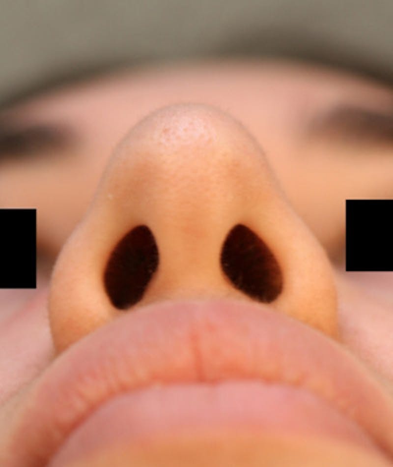 Ethnic Rhinoplasty Before & After Gallery - Patient 108189863 - Image 7