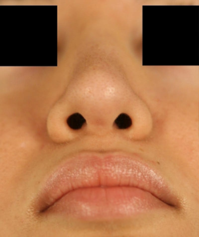 Ethnic Rhinoplasty Before & After Gallery - Patient 108189863 - Image 8