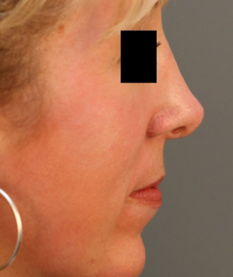 Ethnic Rhinoplasty Before & After Gallery - Patient 108189864 - Image 1