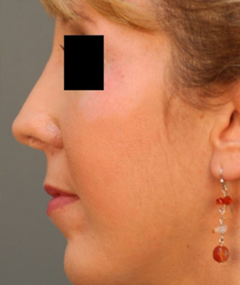 Ethnic Rhinoplasty Before & After Gallery - Patient 108189864 - Image 2