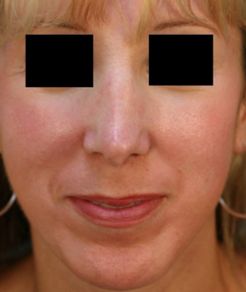 Ethnic Rhinoplasty Before & After Gallery - Patient 108189864 - Image 3