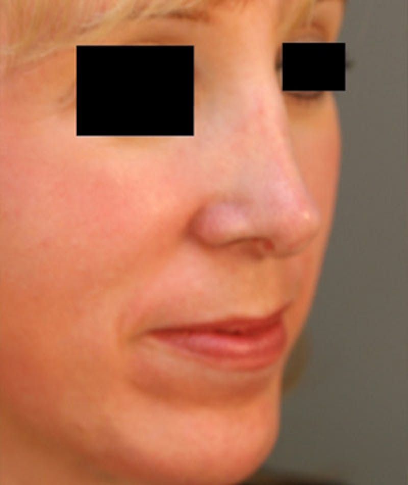 Ethnic Rhinoplasty Before & After Gallery - Patient 108189864 - Image 5
