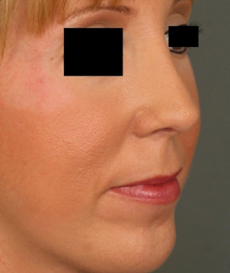 Ethnic Rhinoplasty Before & After Gallery - Patient 108189864 - Image 6