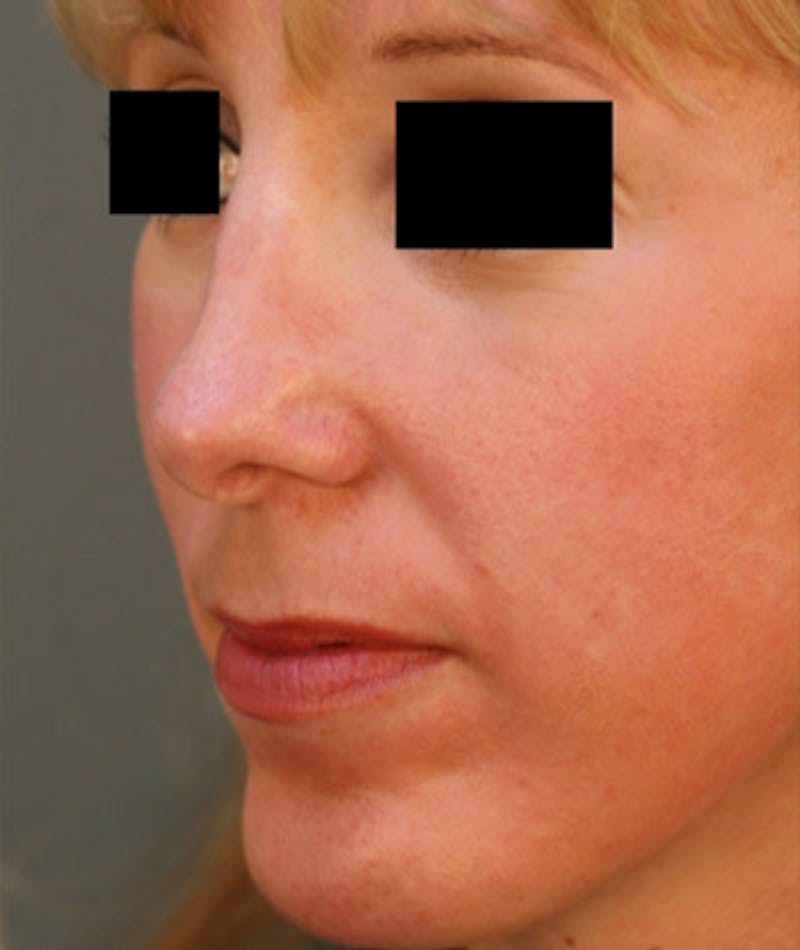 Ethnic Rhinoplasty Before & After Gallery - Patient 108189864 - Image 7