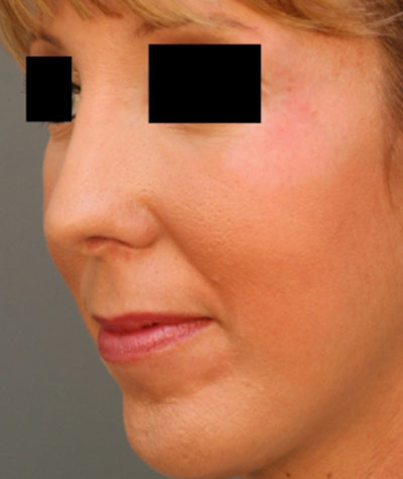 Ethnic Rhinoplasty Before & After Gallery - Patient 108189864 - Image 8