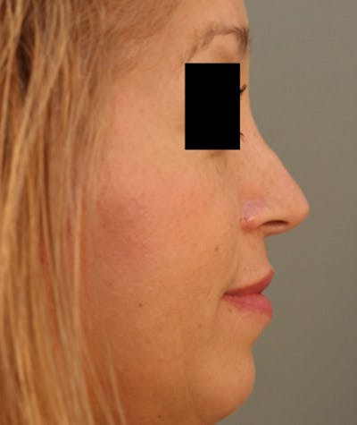 Ethnic Rhinoplasty Before & After Gallery - Patient 108189884 - Image 1