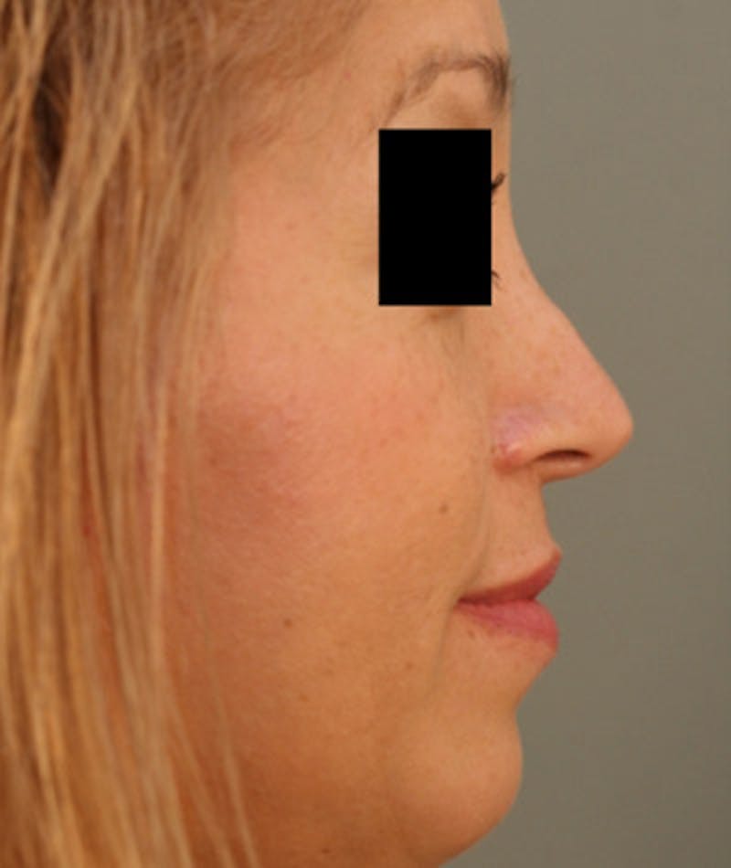 Ethnic Rhinoplasty Before & After Gallery - Patient 108189884 - Image 1