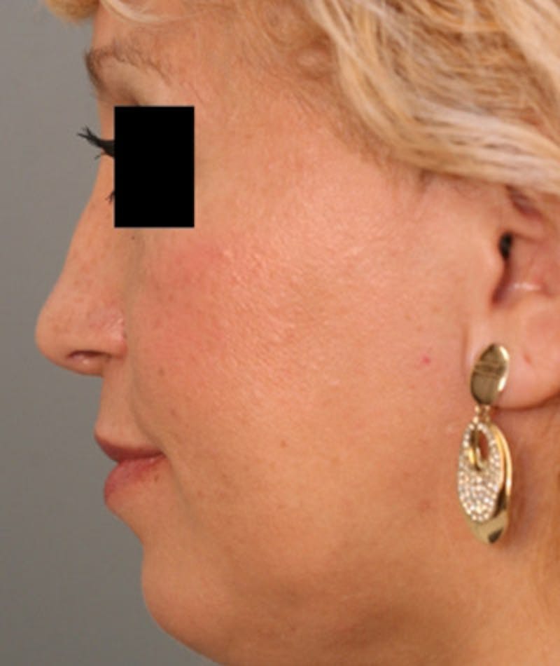 Ethnic Rhinoplasty Before & After Gallery - Patient 108189884 - Image 2
