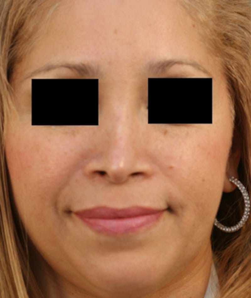 Ethnic Rhinoplasty Before & After Gallery - Patient 108189884 - Image 3