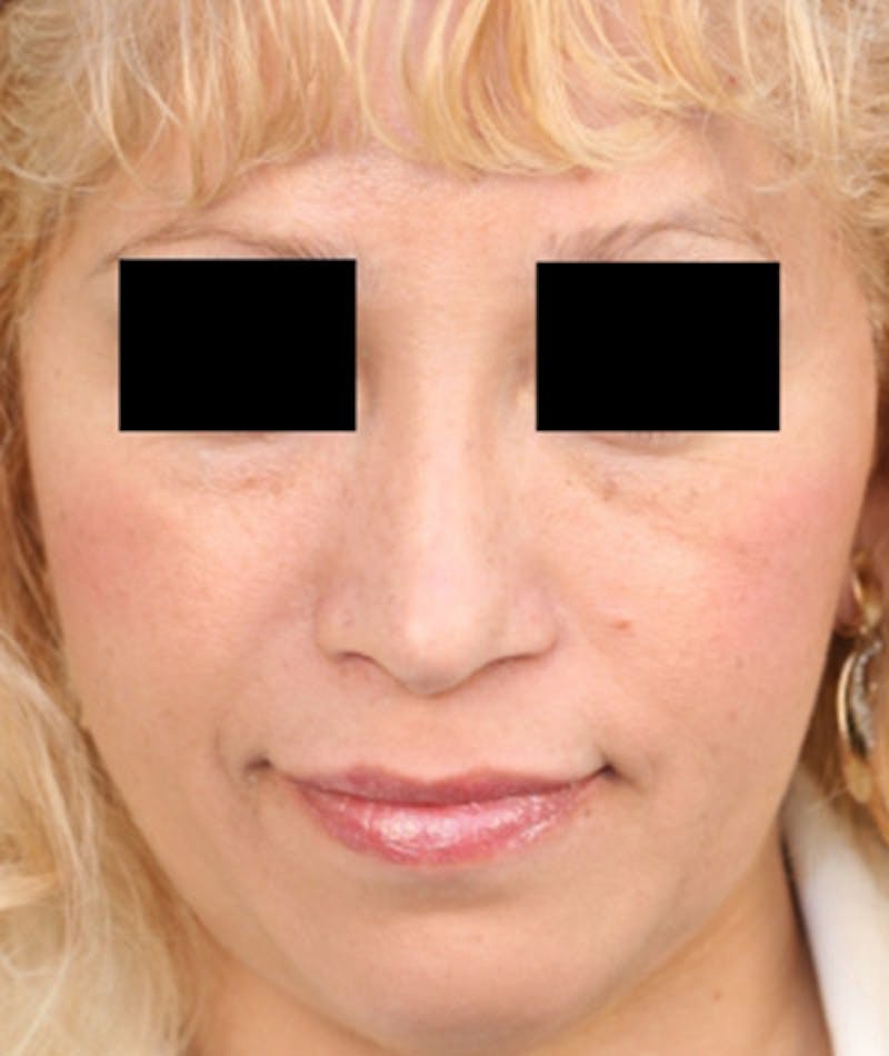 Ethnic Rhinoplasty Before & After Gallery - Patient 108189884 - Image 4