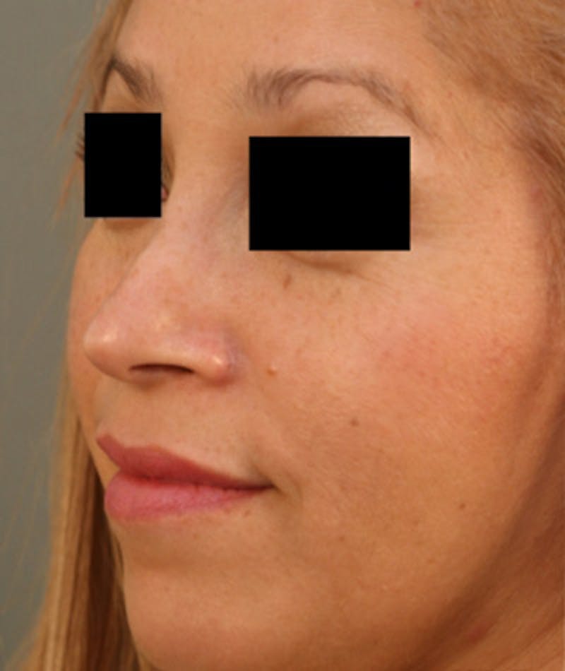 Ethnic Rhinoplasty Before & After Gallery - Patient 108189884 - Image 5