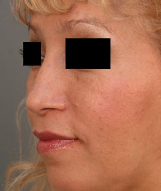 Ethnic Rhinoplasty Before & After Gallery - Patient 108189884 - Image 6