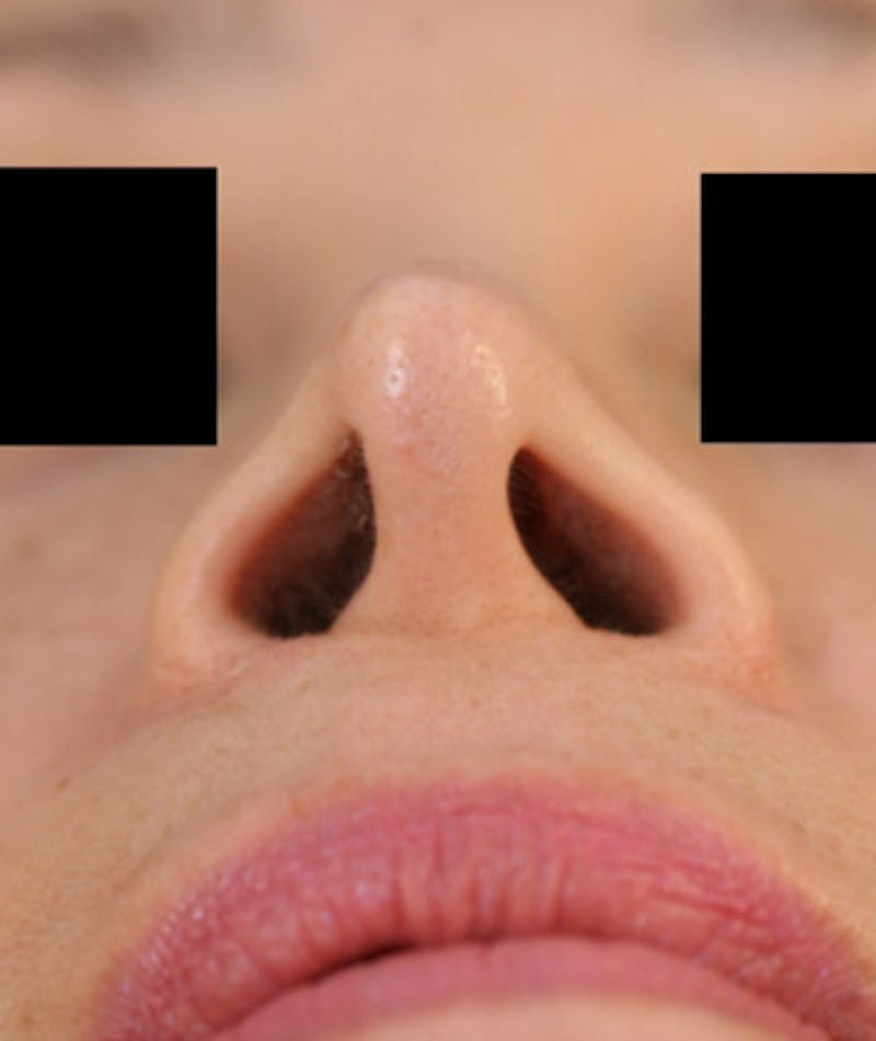 Ethnic Rhinoplasty Before & After Gallery - Patient 108189884 - Image 7