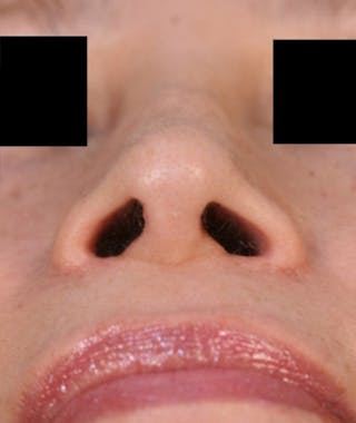Ethnic Rhinoplasty Before & After Gallery - Patient 108189884 - Image 8