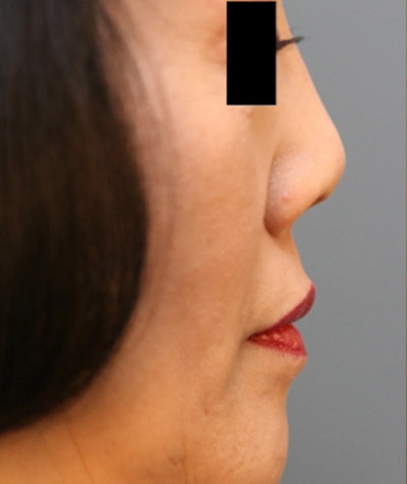 Ethnic Rhinoplasty Before & After Gallery - Patient 108189885 - Image 1