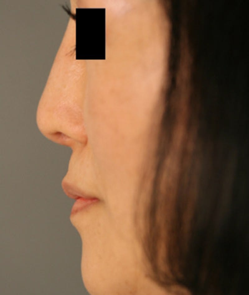 Ethnic Rhinoplasty Before & After Gallery - Patient 108189885 - Image 2