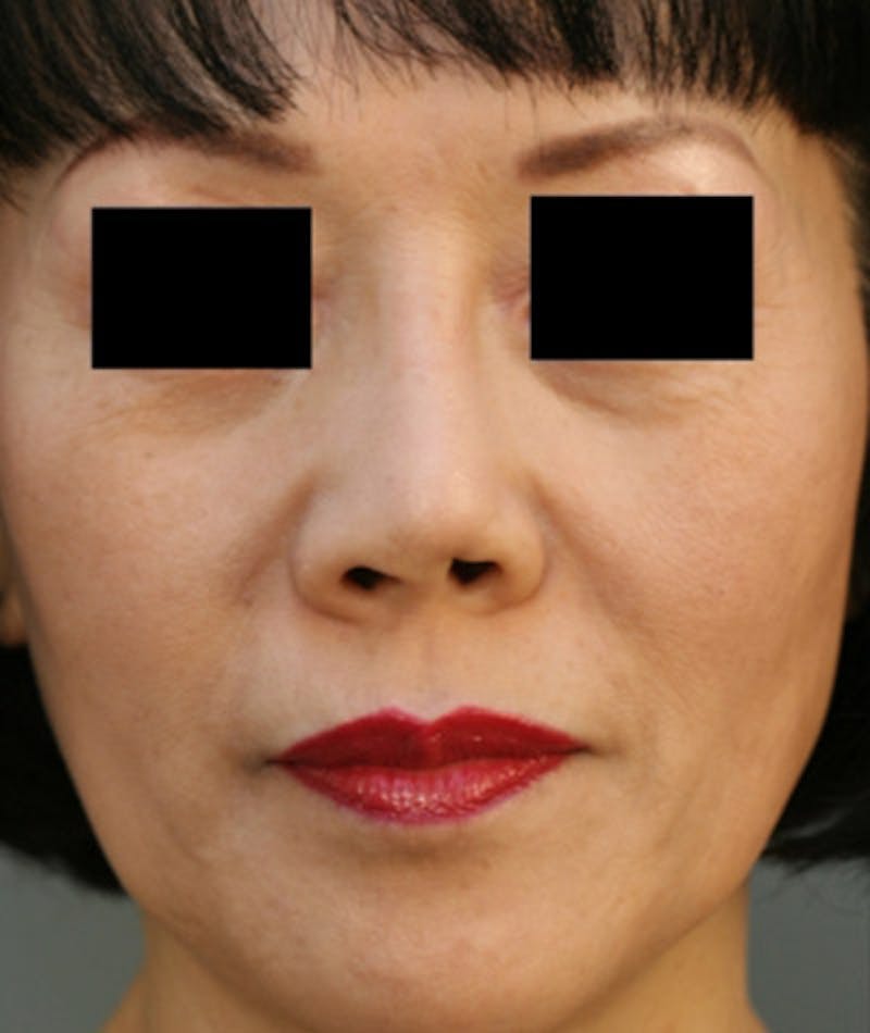 Ethnic Rhinoplasty Before & After Gallery - Patient 108189885 - Image 3