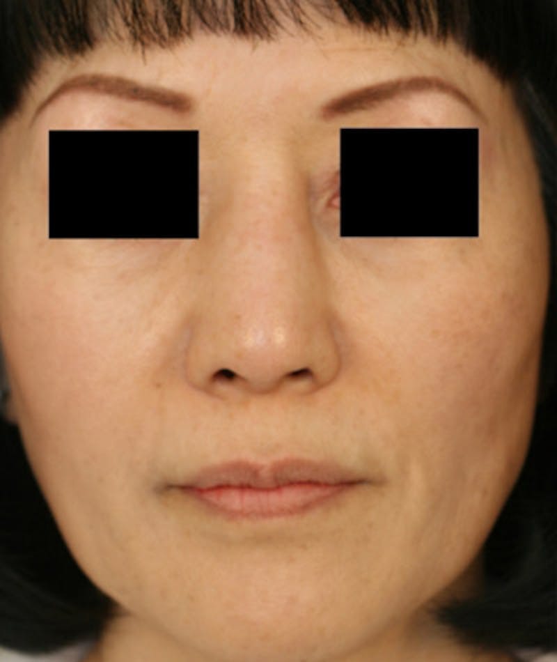 Ethnic Rhinoplasty Before & After Gallery - Patient 108189885 - Image 4