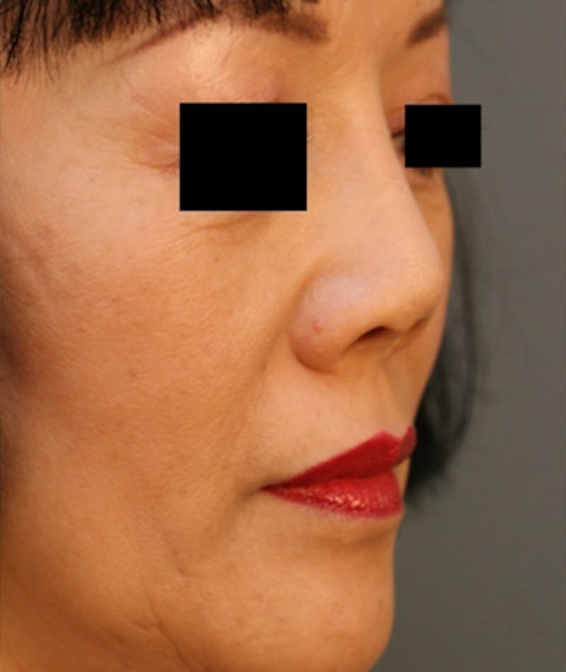 Ethnic Rhinoplasty Before & After Gallery - Patient 108189885 - Image 5