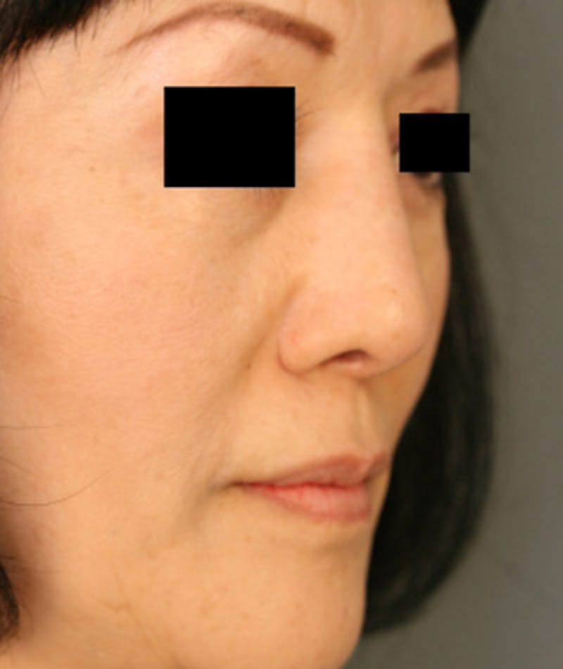 Ethnic Rhinoplasty Before & After Gallery - Patient 108189885 - Image 6