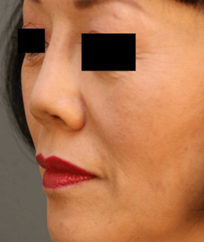 Ethnic Rhinoplasty Before & After Gallery - Patient 108189885 - Image 7