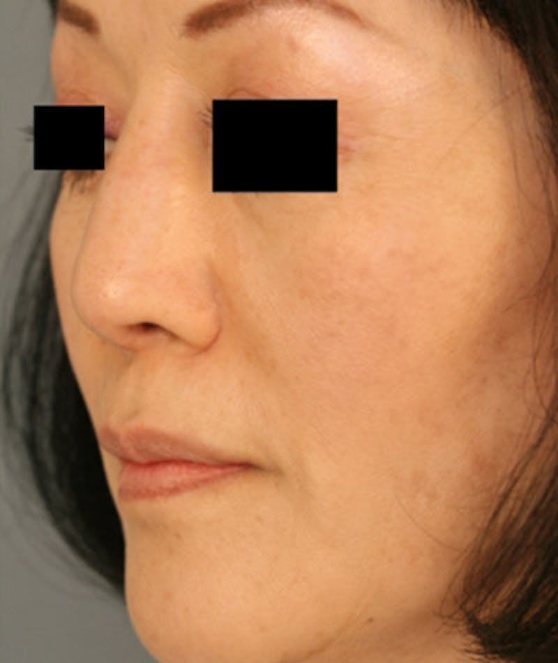Ethnic Rhinoplasty Before & After Gallery - Patient 108189885 - Image 8