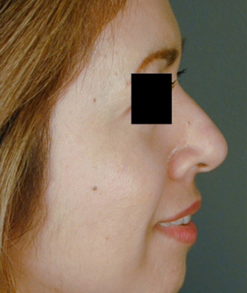 Ethnic Rhinoplasty Before & After Gallery - Patient 108189887 - Image 1