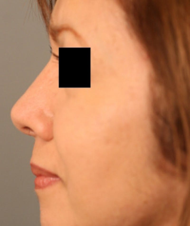Ethnic Rhinoplasty Before & After Gallery - Patient 108189887 - Image 2